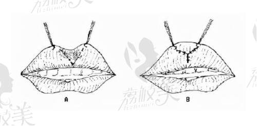 梁安裕醫(yī)生唇部修復(fù)怎么樣