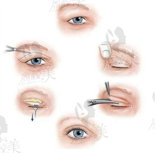 双眼皮手术操作过程