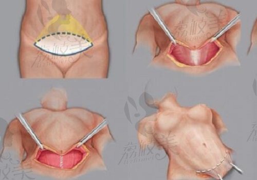 腹壁成形术横切口腔示意图