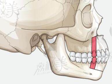 如何预防牙槽骨突出？