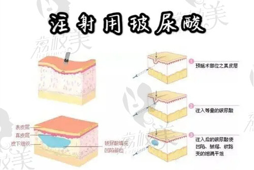 中山韓妃玻尿酸注射價(jià)格