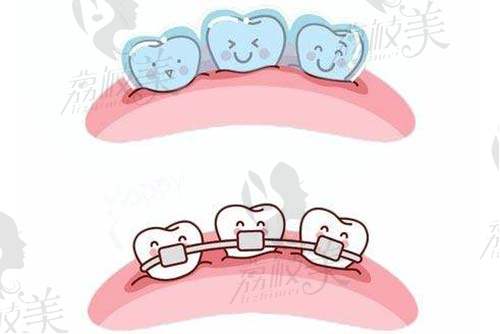 牙齿矫正示意图