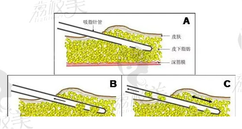 中山爱思特胡可斌做吸脂修复技术靠谱