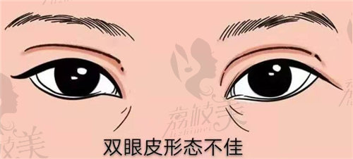 王荣锡医生做双眼皮修复怎么样？