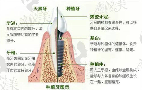 种植牙才2980元