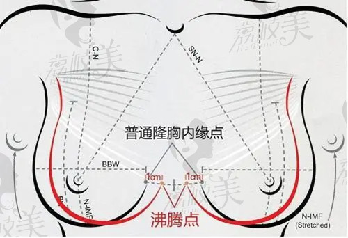 海峡沸腾隆胸术