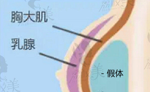 珠海新颜曾超医生做假体隆胸好不好