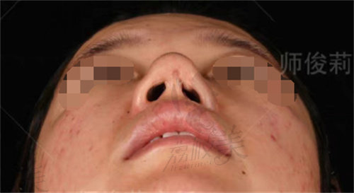 西安唇裂鼻畸形修复手术