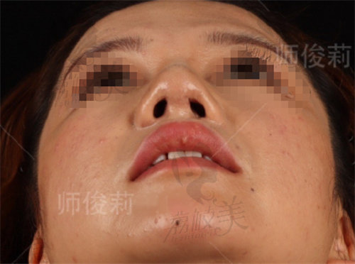 唇裂鼻畸形二期修复术后反馈