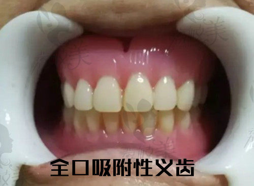 吸附性义齿价格