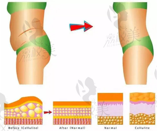 青岛诺德做抽脂后平整不凹凸的原因是啥？