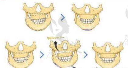 正颌手术的手术方式