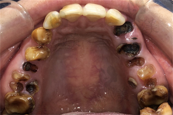  虫牙里面真的有虫吗？