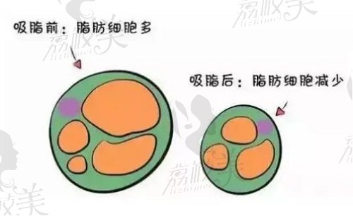 北京雅靓张春彦医生吸脂成效