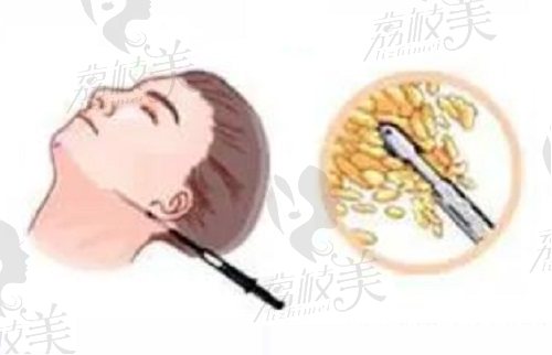 北京雅靚張春彥醫(yī)生面部吸脂 北京雅靚張春彥醫(yī)生面部吸脂