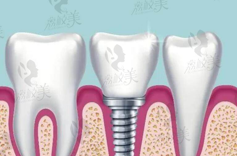 上海宝山区牙科医院种植牙