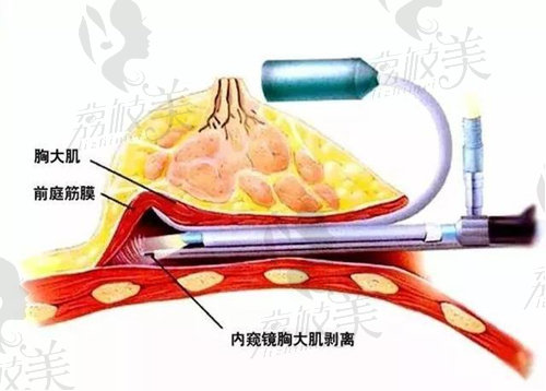 內(nèi)窺鏡演示圖