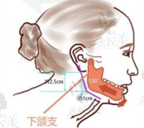 赵延峰做下颌角截骨手术多钱？