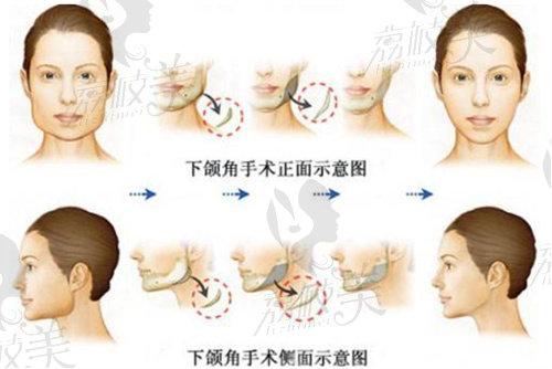 趙延峰做下頜角截骨技術(shù)特色