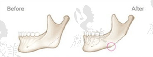 赵延峰做磨骨手术价格