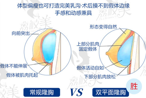 唐新辉双平面隆胸