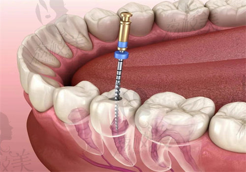 牙齿根管图