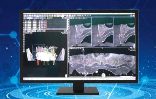 数字化微创种植牙