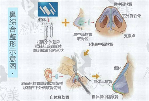 鼻綜合手術示意圖