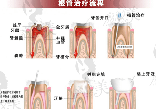 牙齿根管治疗