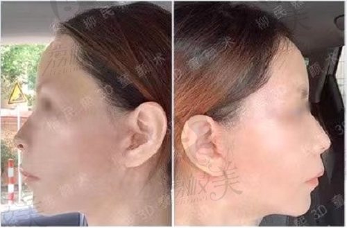 柳民熙面部提升3D童颜术后30天