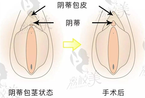成都九龙医院孙梅做小阴唇整形有哪些优势？