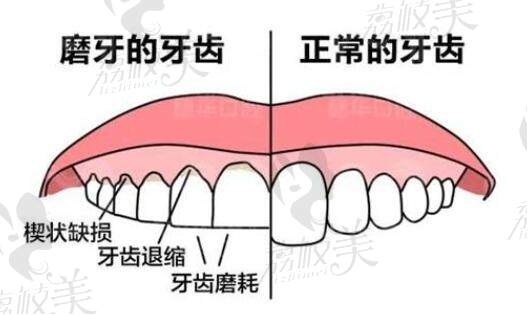 牙齿磨损出现的原因