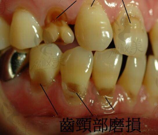牙齿磨损修复的方法，不管是后槽牙还是前牙都适用
