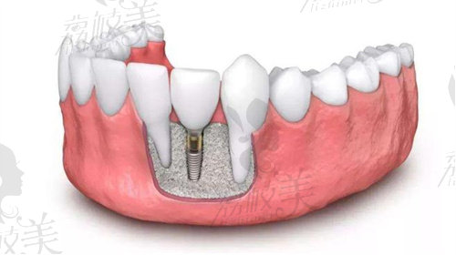 泰康拜博种植牙怎么样