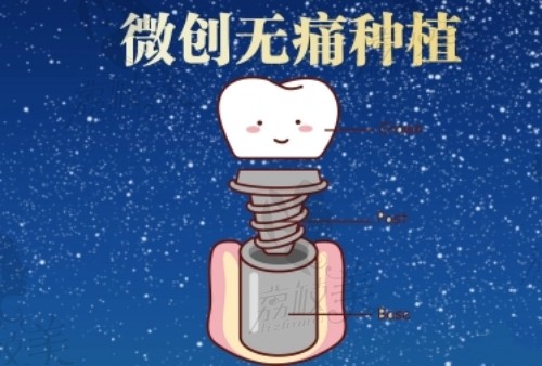 广州广大口腔医院种植牙收费标准公布
