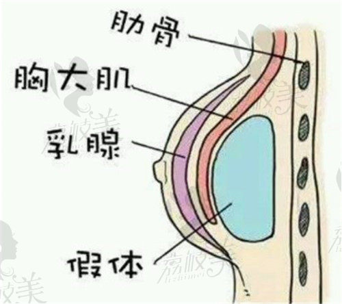 假体内窥镜双平面隆胸技术