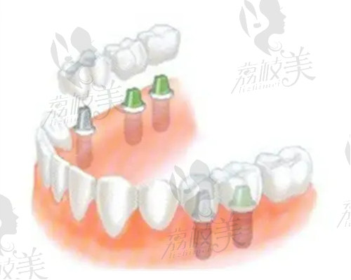 暨南大学穗华口腔医院种植牙参考价格表