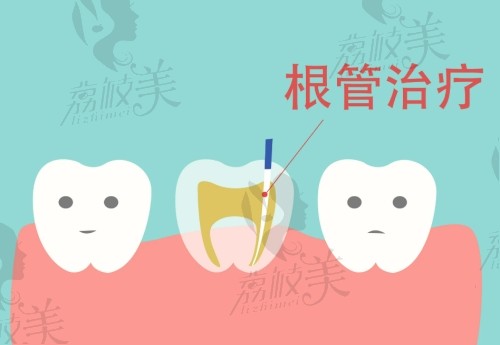 暨南大学穗华口腔医院牙髓治疗参考价格表