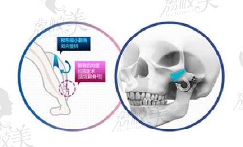 张立天颧骨颧弓内推磨骨术