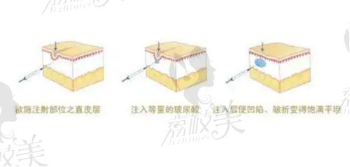 珠海熙尔曼玻尿酸注射价格表