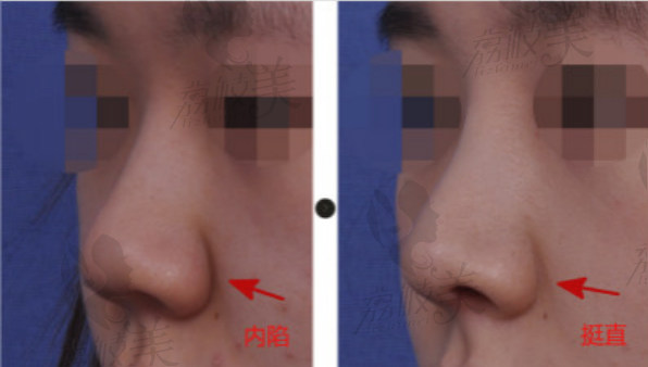 韩国韩娜鼻整形医院-自体软骨隆鼻