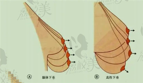 赵进军医生的胸部下垂矫正技术赞