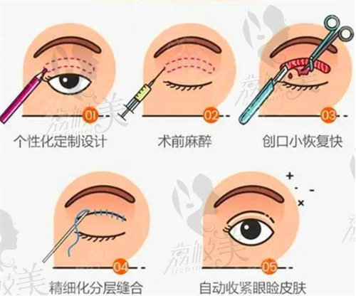 林建新医生做眼部综合整形技术优势