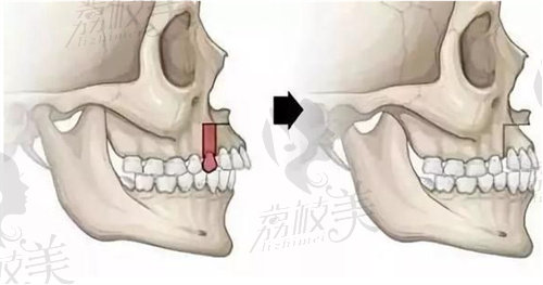 骨性龅牙的手术治疗图片
