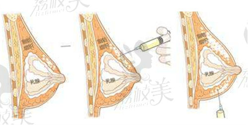 昆明梦想整形医院隆胸好不好