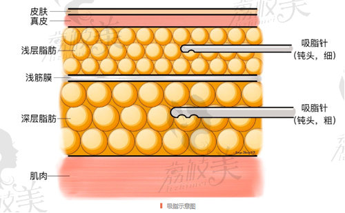 溫州吸脂哪家醫(yī)院做的好？