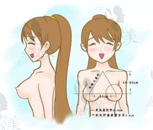 自体脂肪隆胸