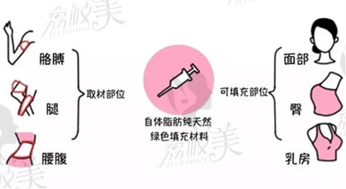 自体脂肪隆胸