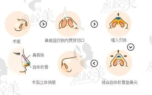 溫州藝星的譚立文醫(yī)生如何做鼻修復(fù)