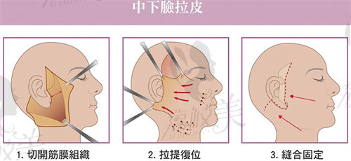 昆明華美美萊郭鵬做小切口拉皮怎么樣